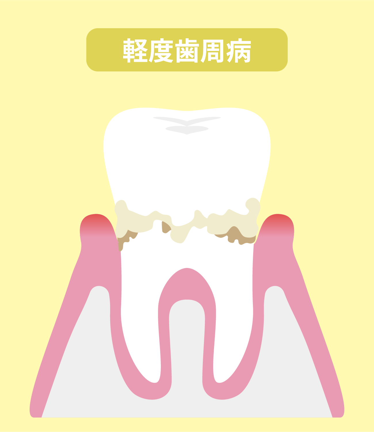 軽度歯周病