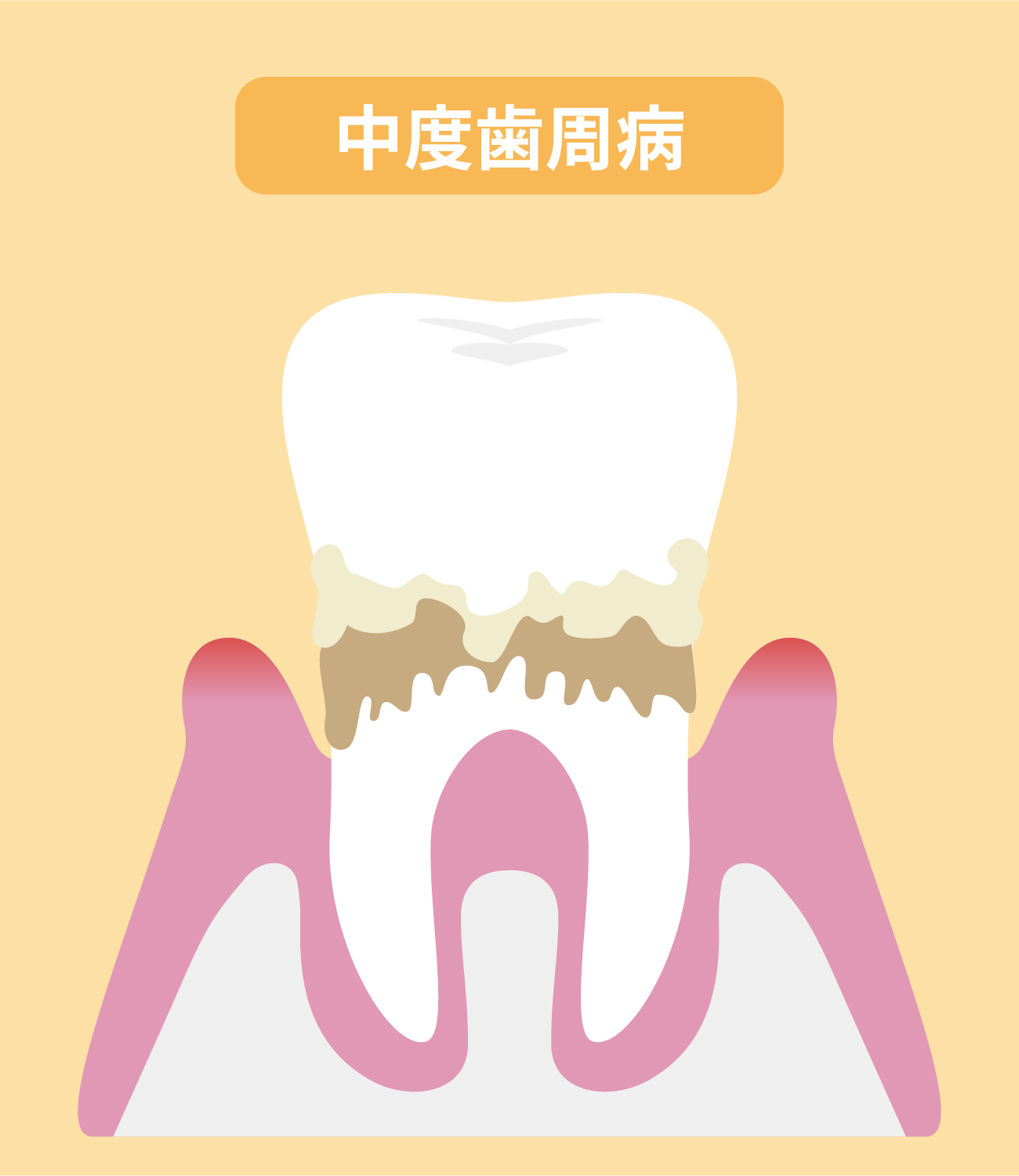 中度歯周病